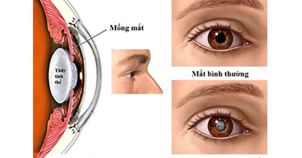 Cách chăm sóc mắt sau mổ đục thủy tinh thể ở người cao tuổi