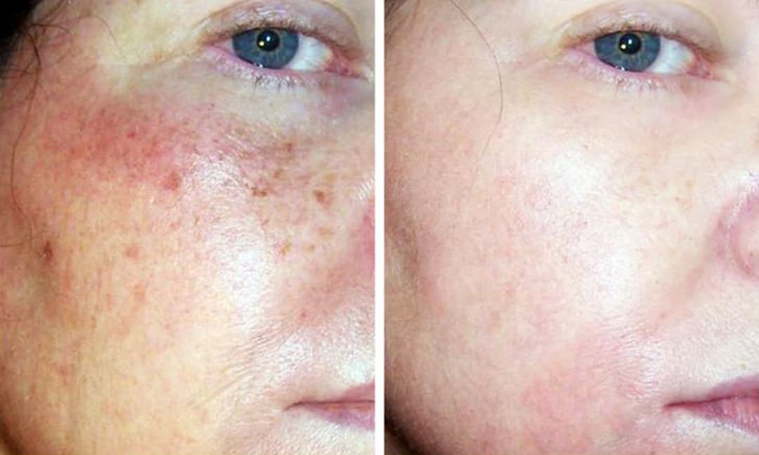 5 sản phẩm chống nếp nhăn có tác dụng không kém việc tiêm thuốc làm đẹp