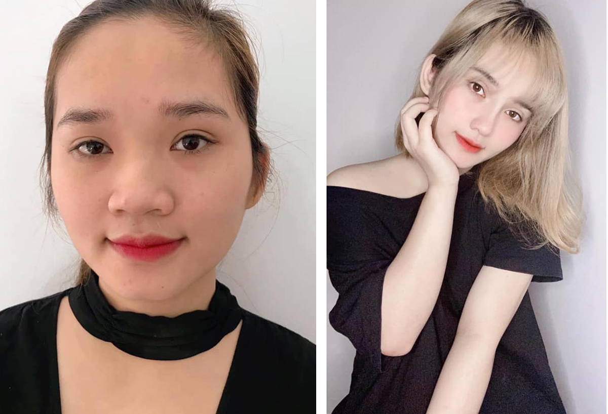 Người trẻ ngày càng chuộng phẫu thuật thẩm mỹ